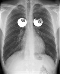 Simmons'  Chest X-Ray